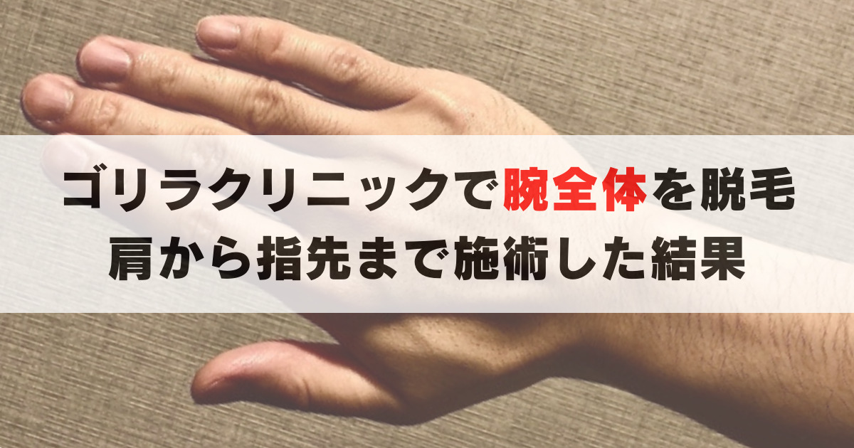 ゴリラクリニックで腕全体(腕,手の甲,指)を脱毛！効果や範囲, 注意点を解説